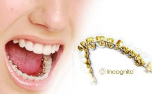 clinica-dental-manrique-y-pedraza-santander-cantabria-ortodoncia-incognito