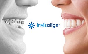 clinica-dental-manrique-y-pedraza-santander-cantabria-ortodoncia-invisalign