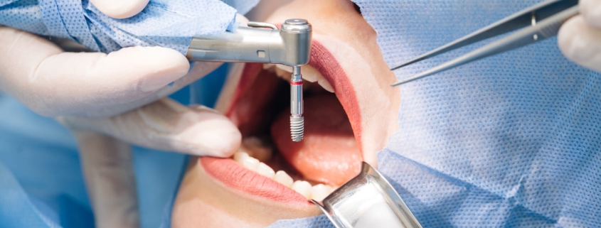 cómo se pone un implante dental
