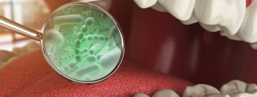 por qué salen las caries