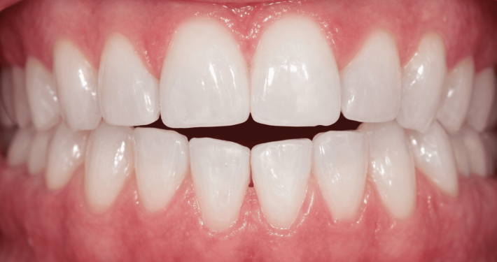 mordida abierta anterior