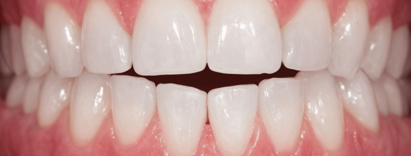 mordida abierta anterior