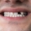 ¿Se pueden poner carillas si faltan dientes?