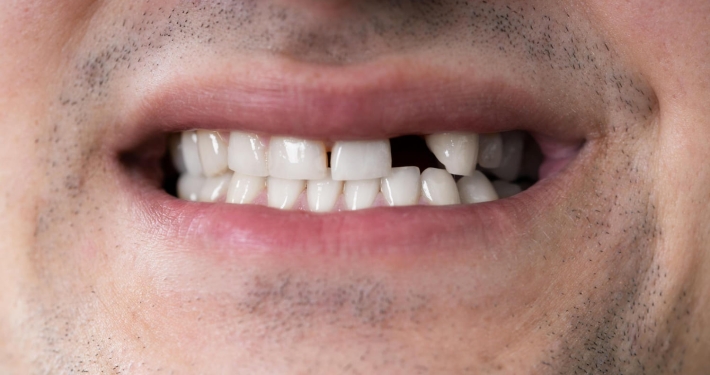 se pueden poner carillas si faltan dientes